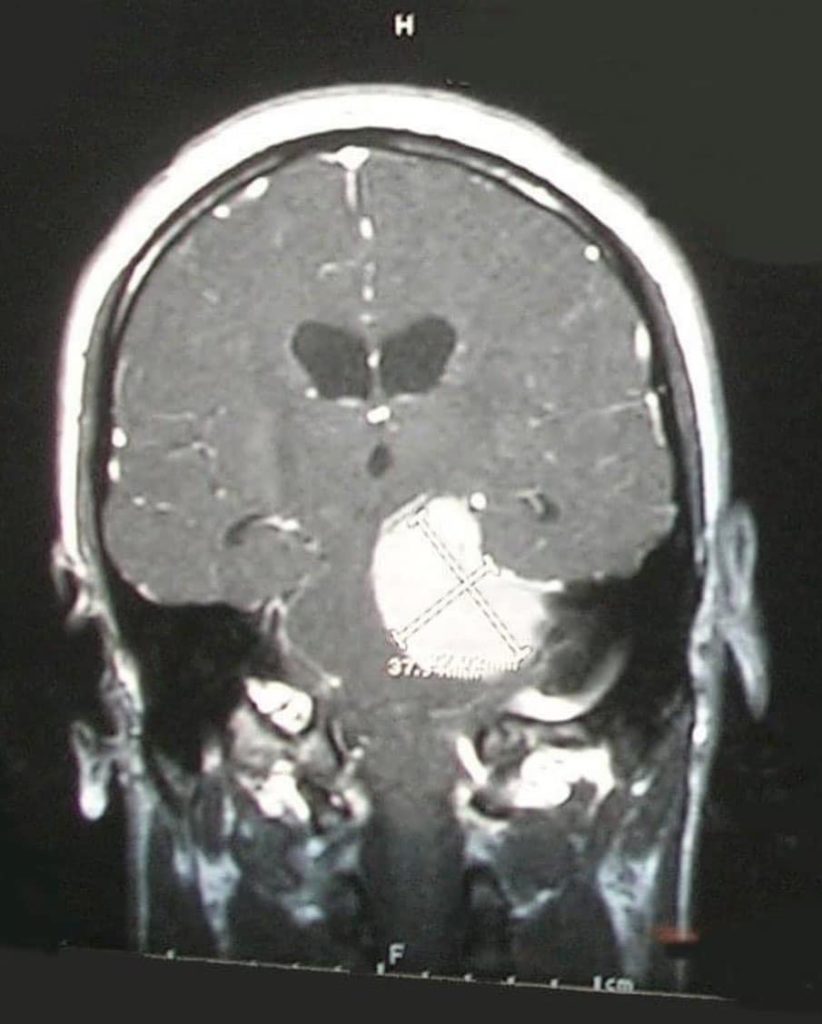 An MRI shows a brain tumor the size of a golf ball.
