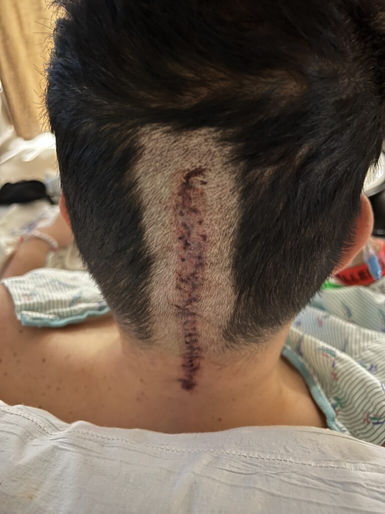 Photo depicts a recent craniotomy scar at the back of a male patient's head.