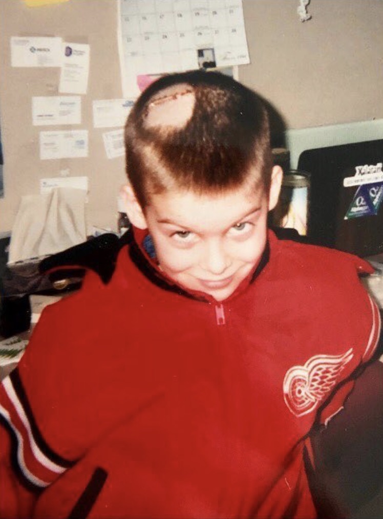 A young boy in a Detroit Red Wings jacket shows off his craniotomy scar following surgery to remove a dysembryoplastic neuroepithelial tumor.