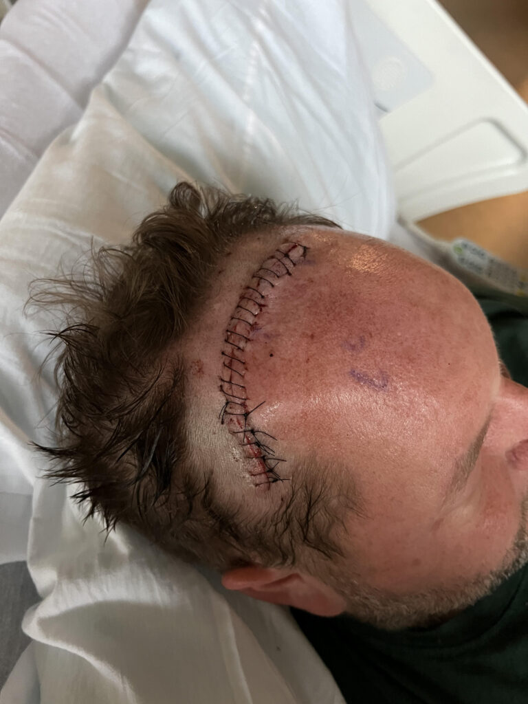 A photo of a man's fresh craniotomy incision in his hospital bed.