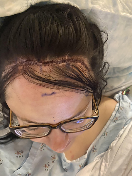 An overhead view of Kelsey's craniotomy scar