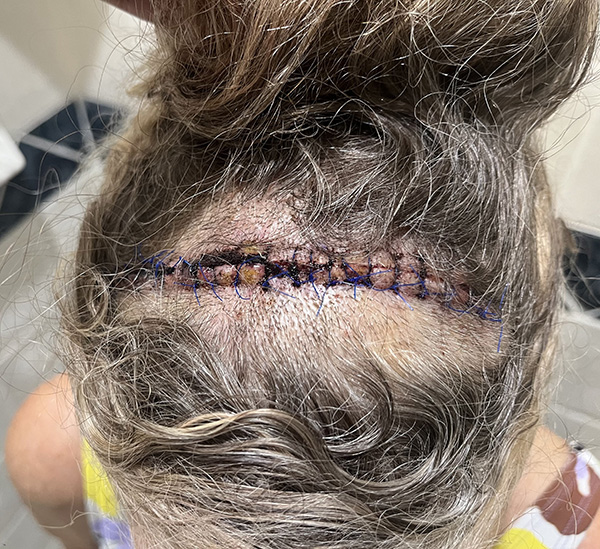 A craniotomy scar on the back of the head after surgery to remove a meningioma brain tumor
