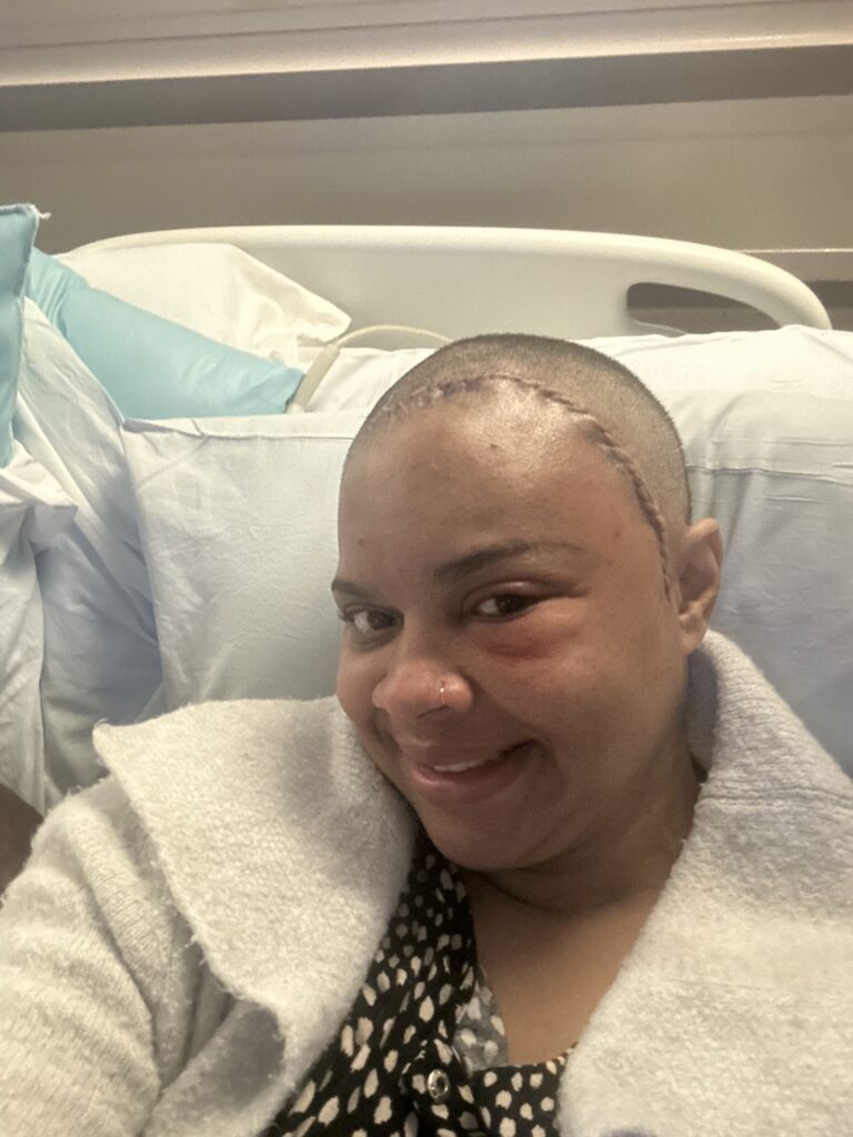 Following a meningioma diagnosis, a woman sits in a hospital bed with a fresh craniotomy scar and the area around her left eye is swollen from surgery to resect a meningioma tumor.