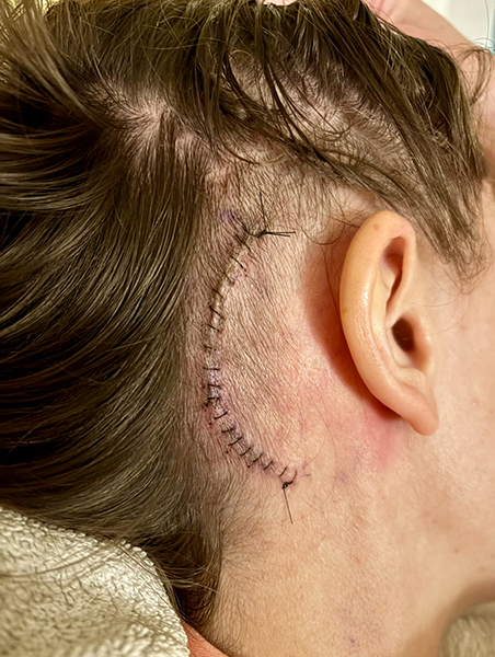 Photo of a woman's head with hair pulled back to reveal a craniotomy incision with stitches behind her right ear. Woman has facial nerve schwannoma.