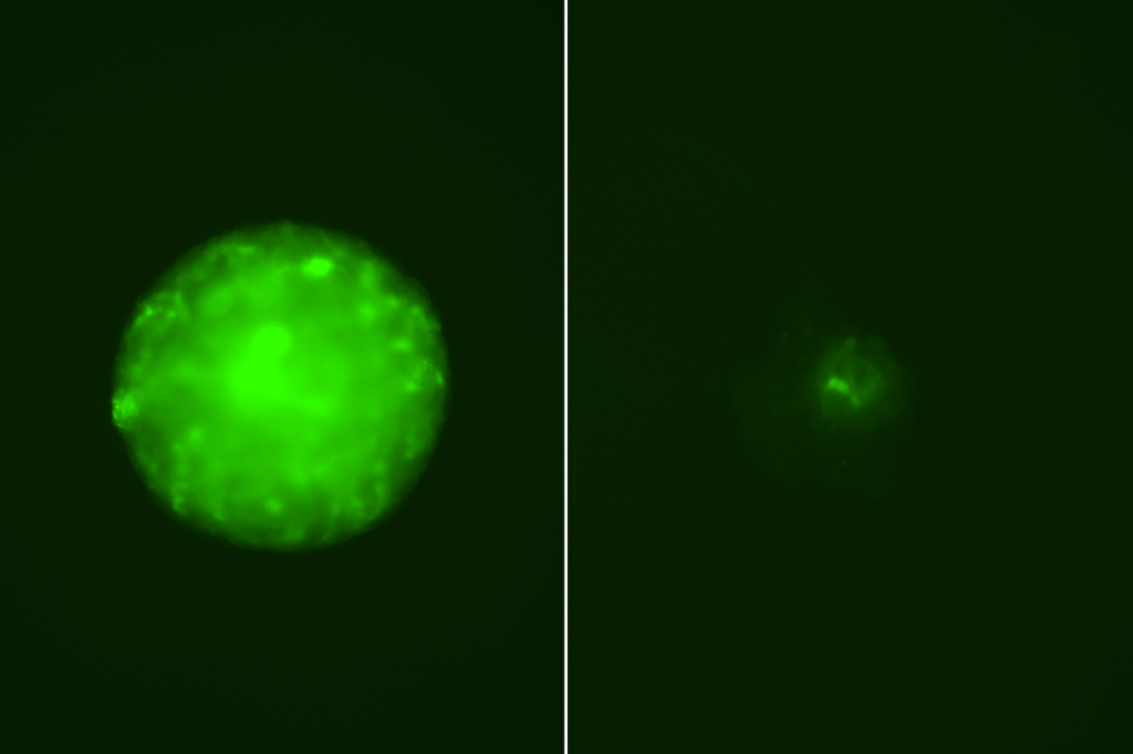 Untreated glioblastoma cells (left) vs. GBM cells treated with a combination of ABBV-155 and radiation (right)