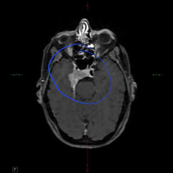 An MRI scan of a brain shows a tumor
