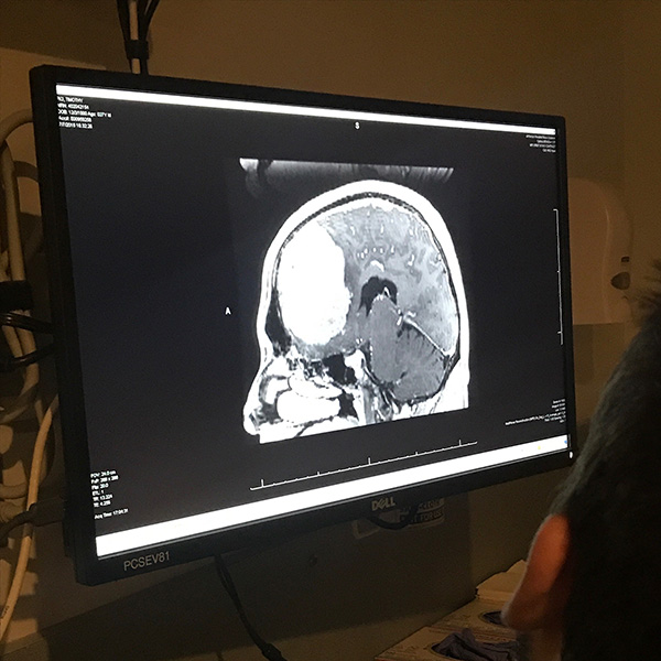 An MRI scan on a computer monitor shows a grapefruit-sized meningioma tumor.
