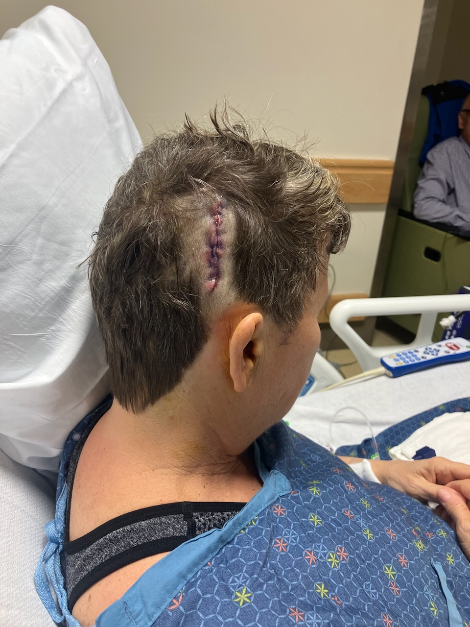 A woman with short hair sits in a hospital bed with her face away from the camera. She has a fresh craniotomy incision from surgery to remove glioblastoma.