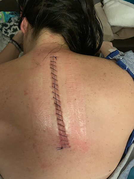 A photo of a woman lying face down in a hospital bed with a fresh incision down her back to resect spinal ependymoma.