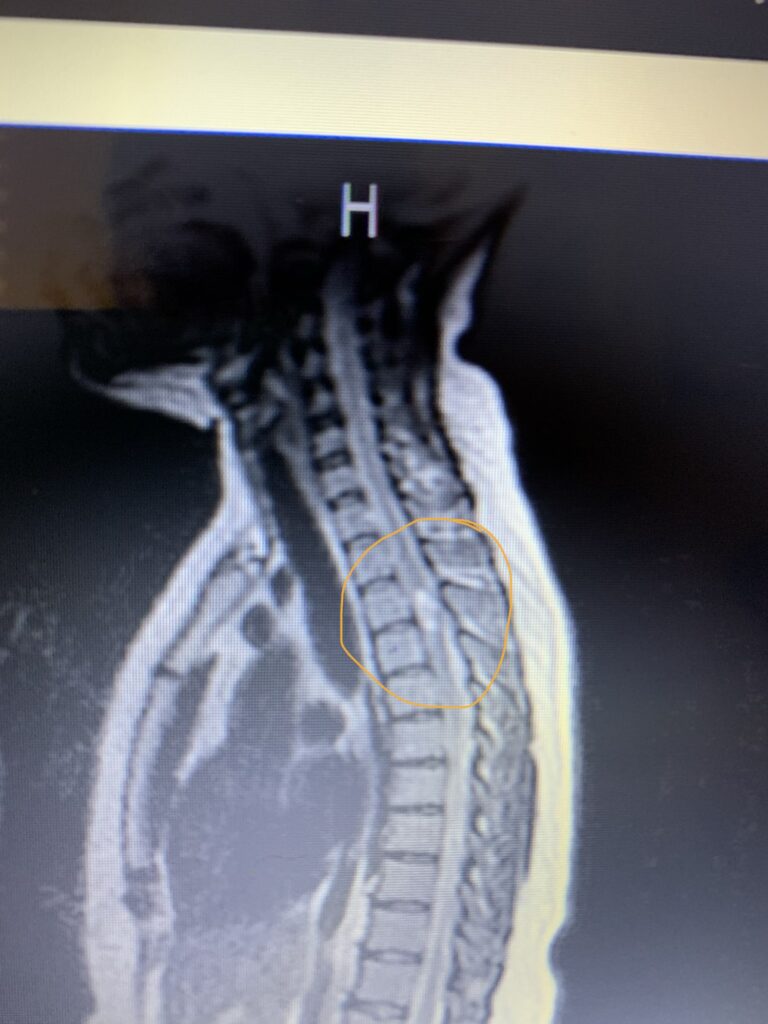An MRI scan showing spinal ependymoma