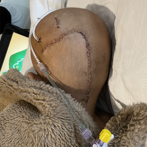 A young boy's ependymoma story includes this photo of him in the hospital bed with a large craniotomy scar and a tube coming out of his head after surgery.